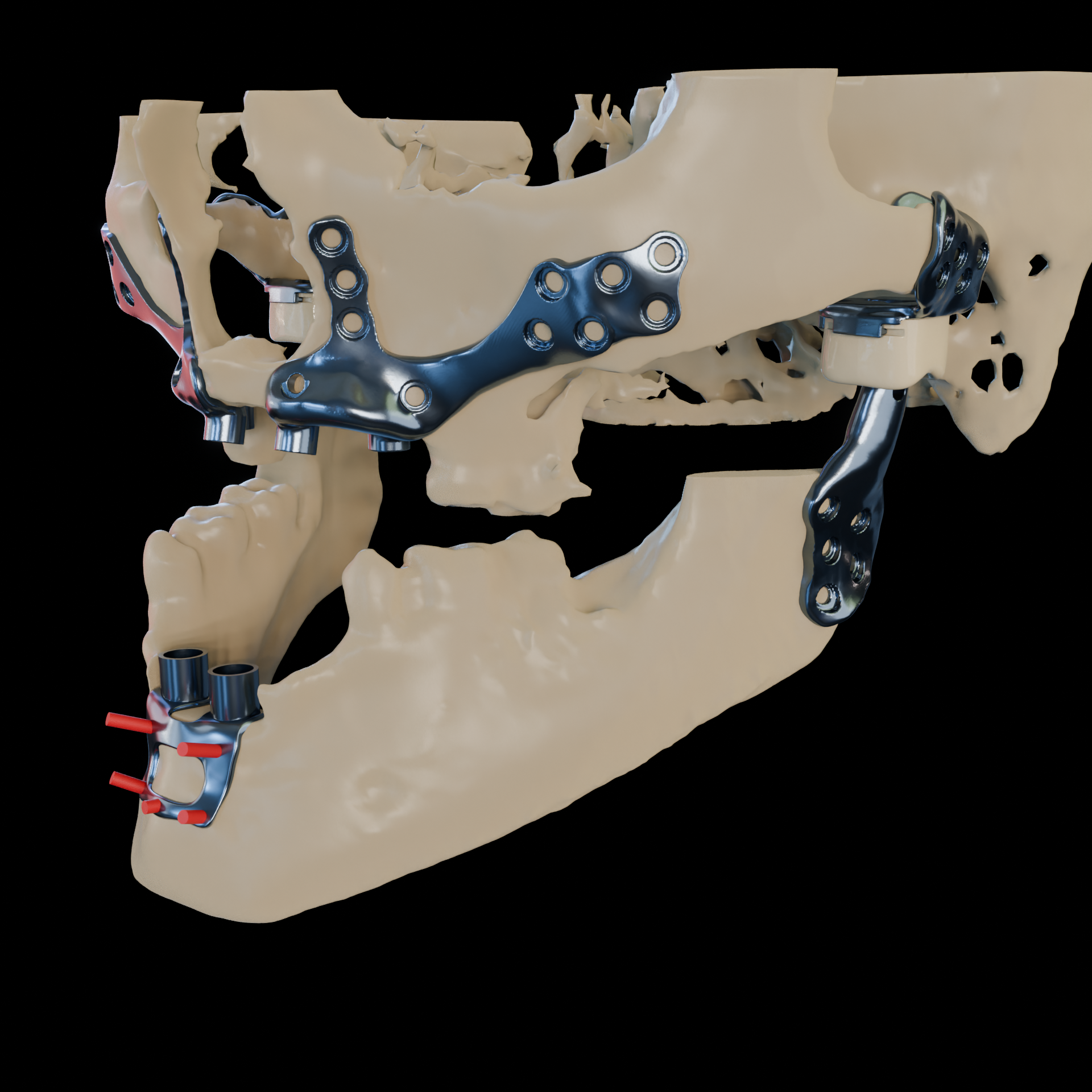 Implant design software showing a 3D bone model being sculpted for a custom framework