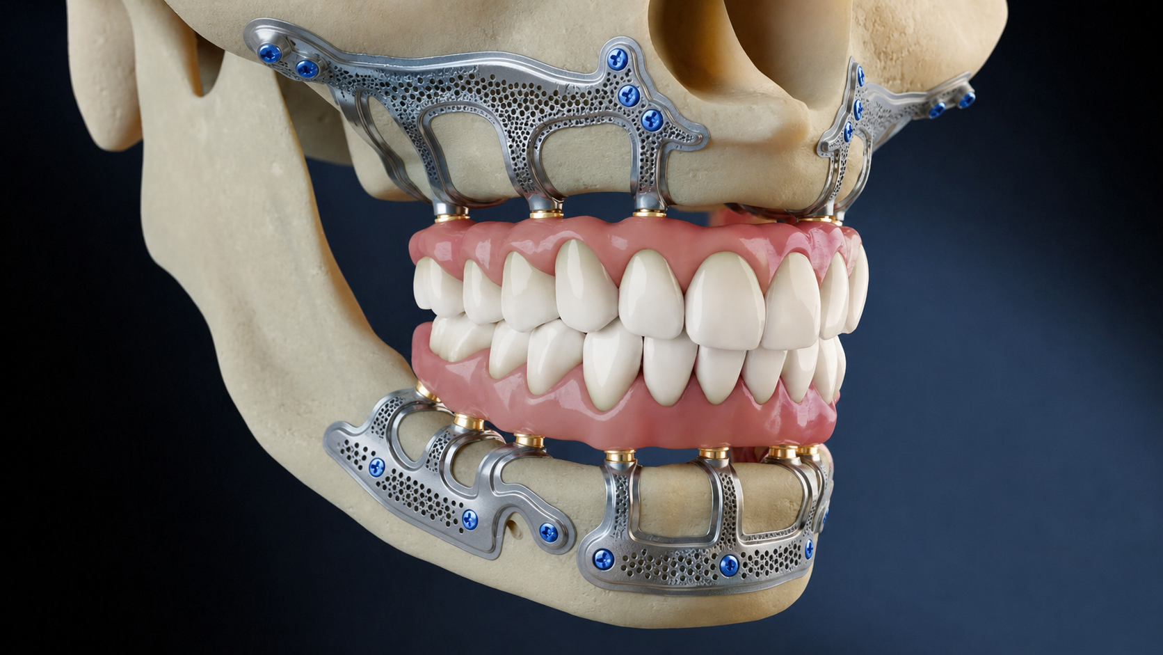 Titanium subperiosteal framework for both upper and lower jaw arches, case model