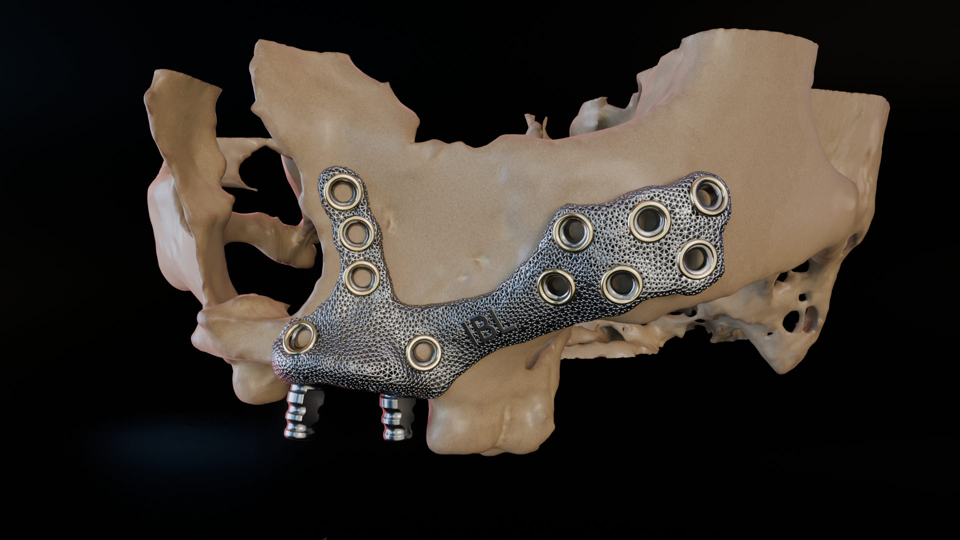 Titanium mandibular framework with fixation screws, side profile on skull model